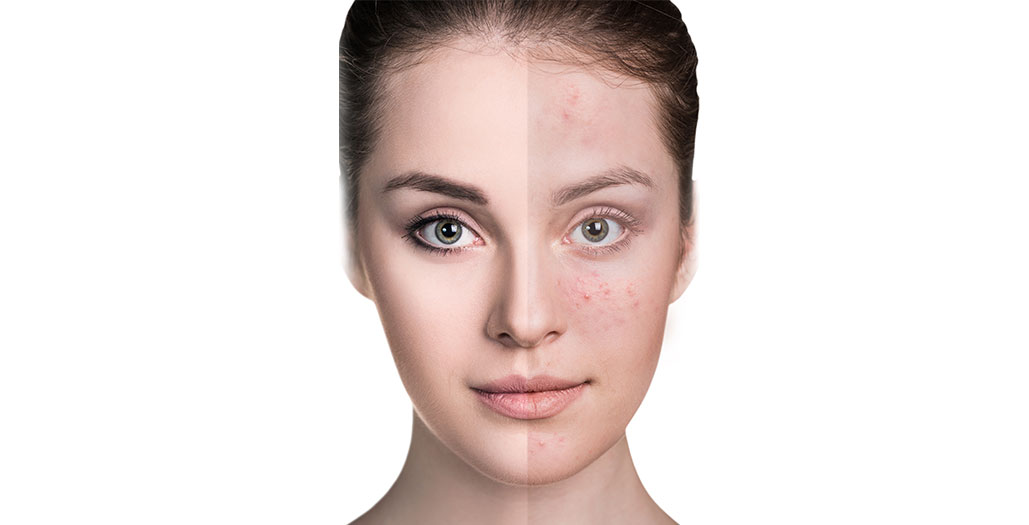 Acne Treatment