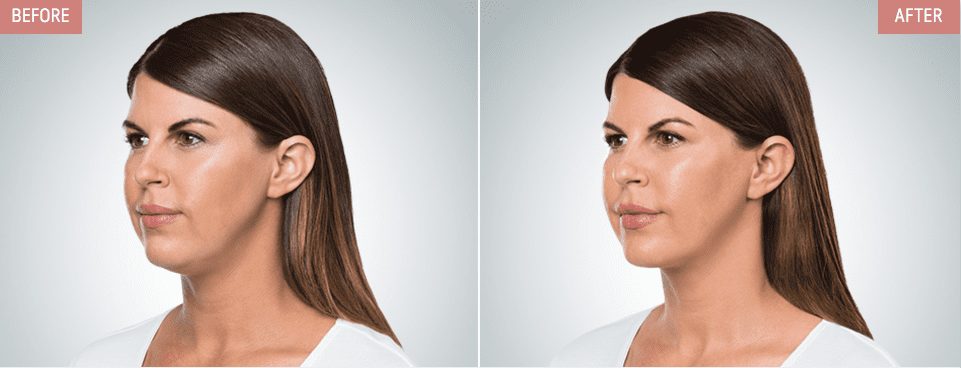 How To Reduce Your Double Chin | The Spa At Spring Ridge