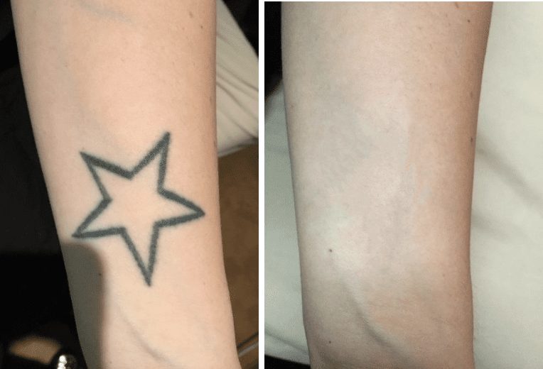 laser tattoo removal results after one session - Sommer Escalante