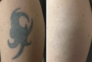 Tattoo Removal With the PicoSure® Laser | The Spa at Spring Ridge