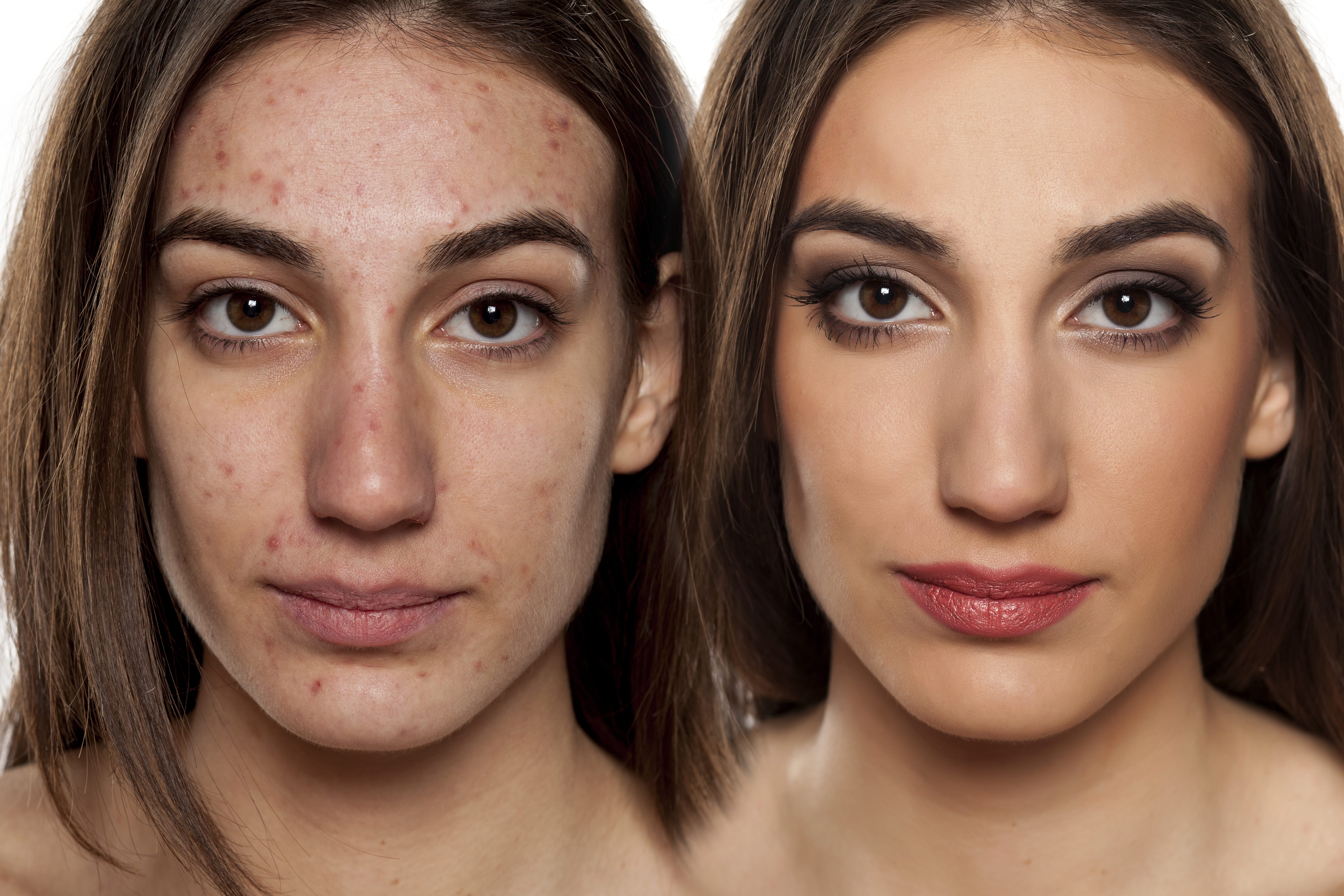 Before And After Woman With Acne Photo Gallery The Spa At Spring Ridge