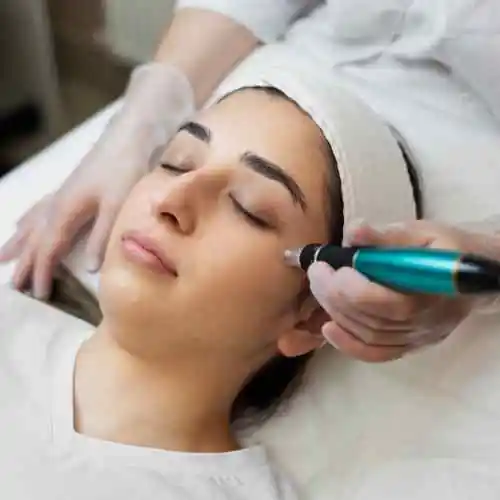 Microneedling Treatment in reading pa