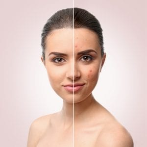 Microneedling for Acne