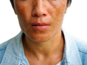 Is Microneedling Good for Melasma?