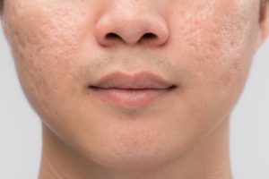 Which Laser Is Best for Acne Scars?