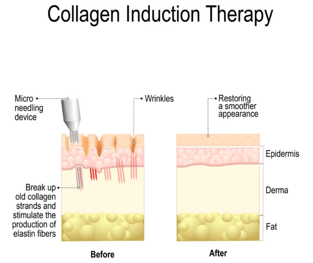Collagen Induction Therapy Infographic