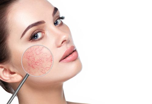 What Treatments Can Address Rosacea?