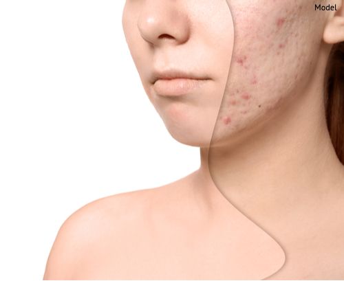 How Does Microneedling Improve Acne Scars? What Else Can It Do?