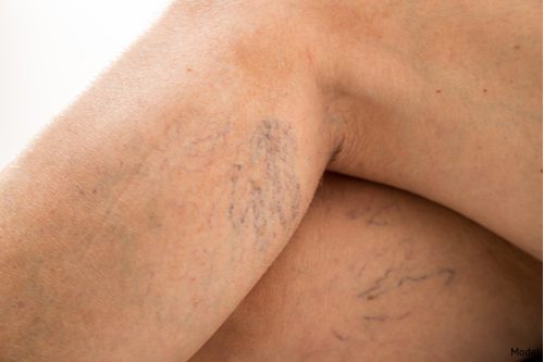 How Can the excel® V Laser System Reduce the Appearance of Spider Veins?