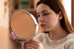 Types of Acne Scars and the Best Treatments for Each
